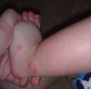 Em bé bị muỗi đốt