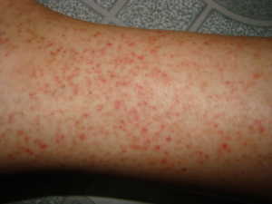 Dấu hiệu bệnh sốt xuất huyết